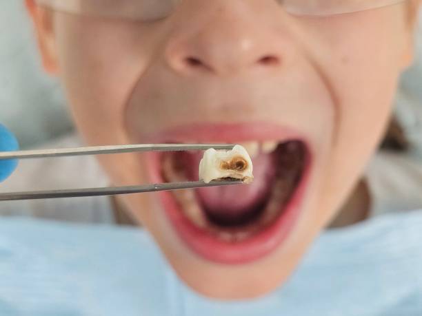 Best Dental Abscess Treatment in Maryville, MO